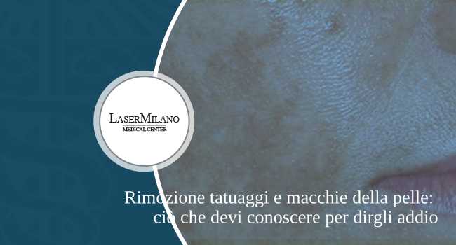 rimozione tatuaggi e macchie della pelle con tecnologia laser q switched nel nostro centro medico di rimozione tatuaggi a Milano
